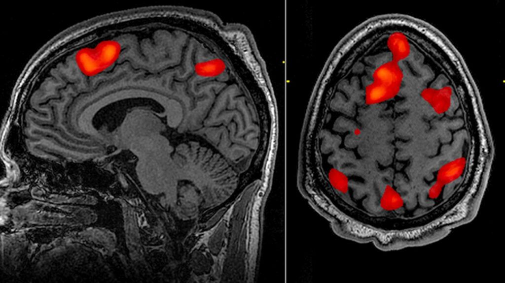 Functional magnetic resonance image