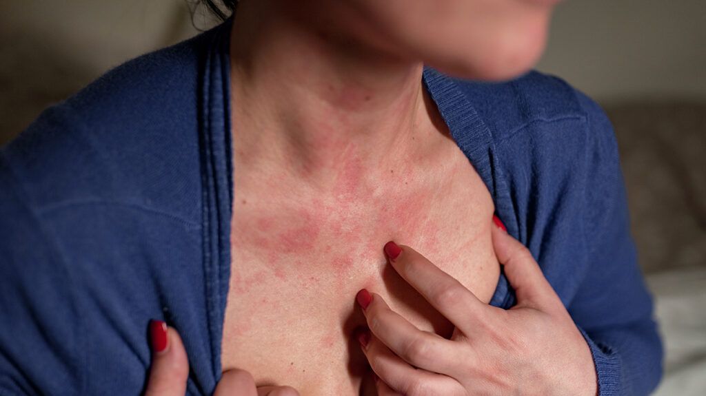Woman scratching anxiety hives