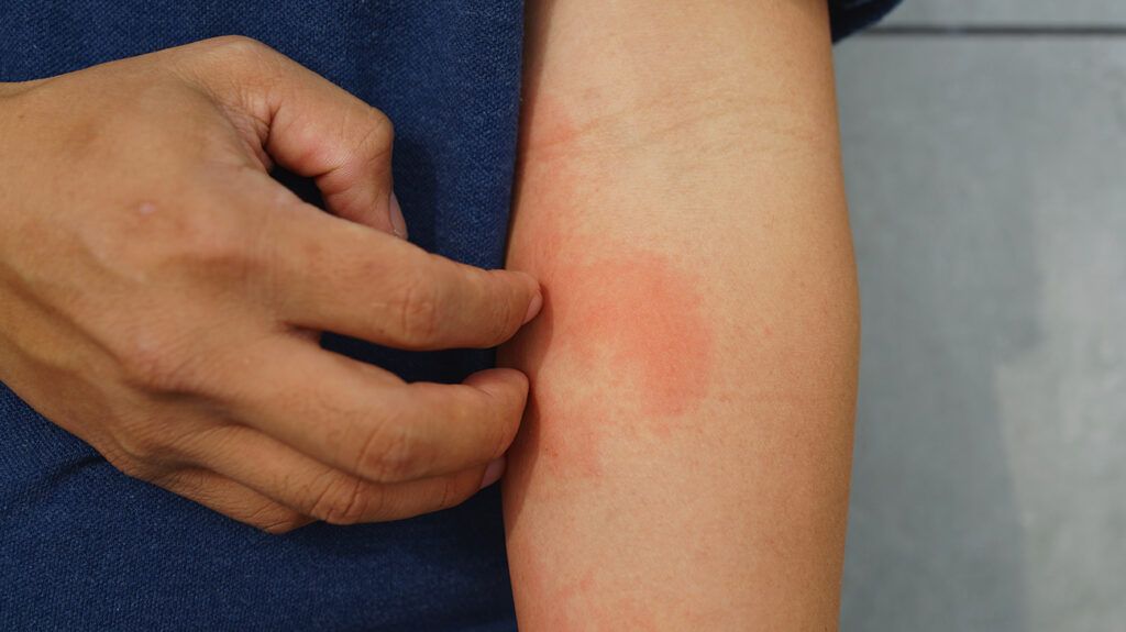 a person scratching a rash on their arm