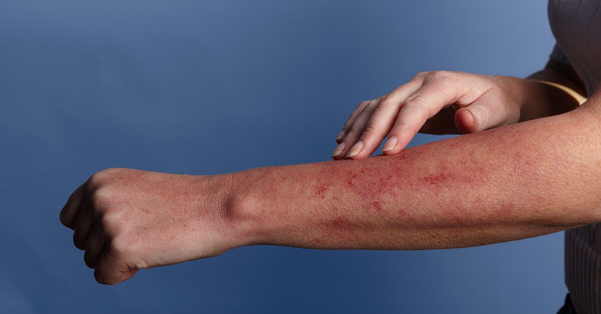 Common Causes of Rashes