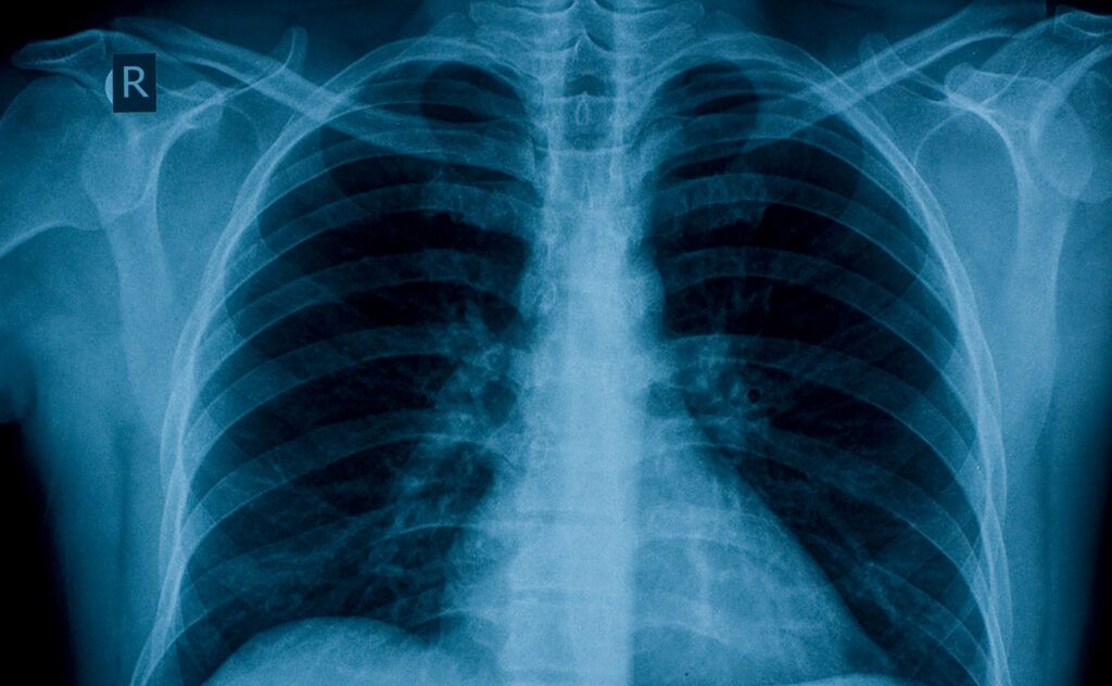 X-ray image of healthy lungs