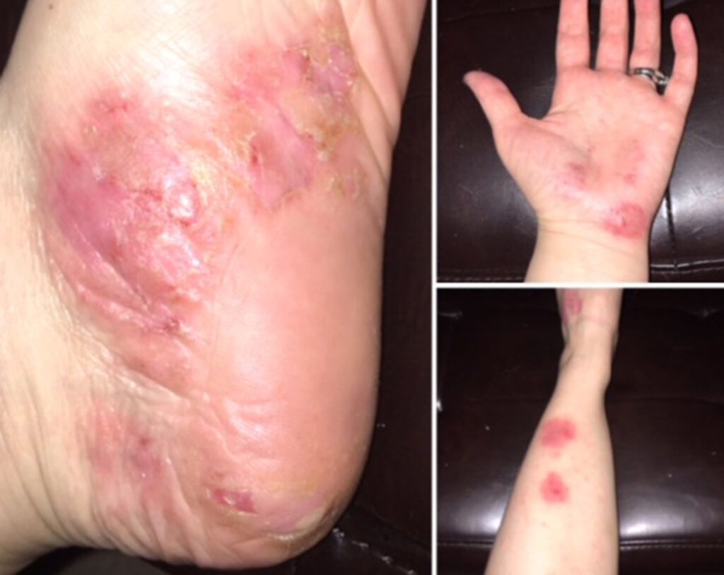 pustular psoriasis