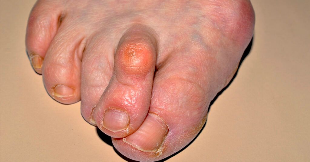 PsA can cause hammer toe, which is when you toe curls downwards rather than pointing forward. 