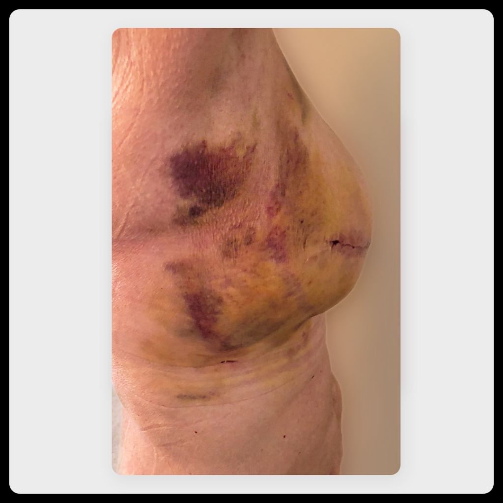 Side view of significant bruising and discoloration one to three months after mastectomy
