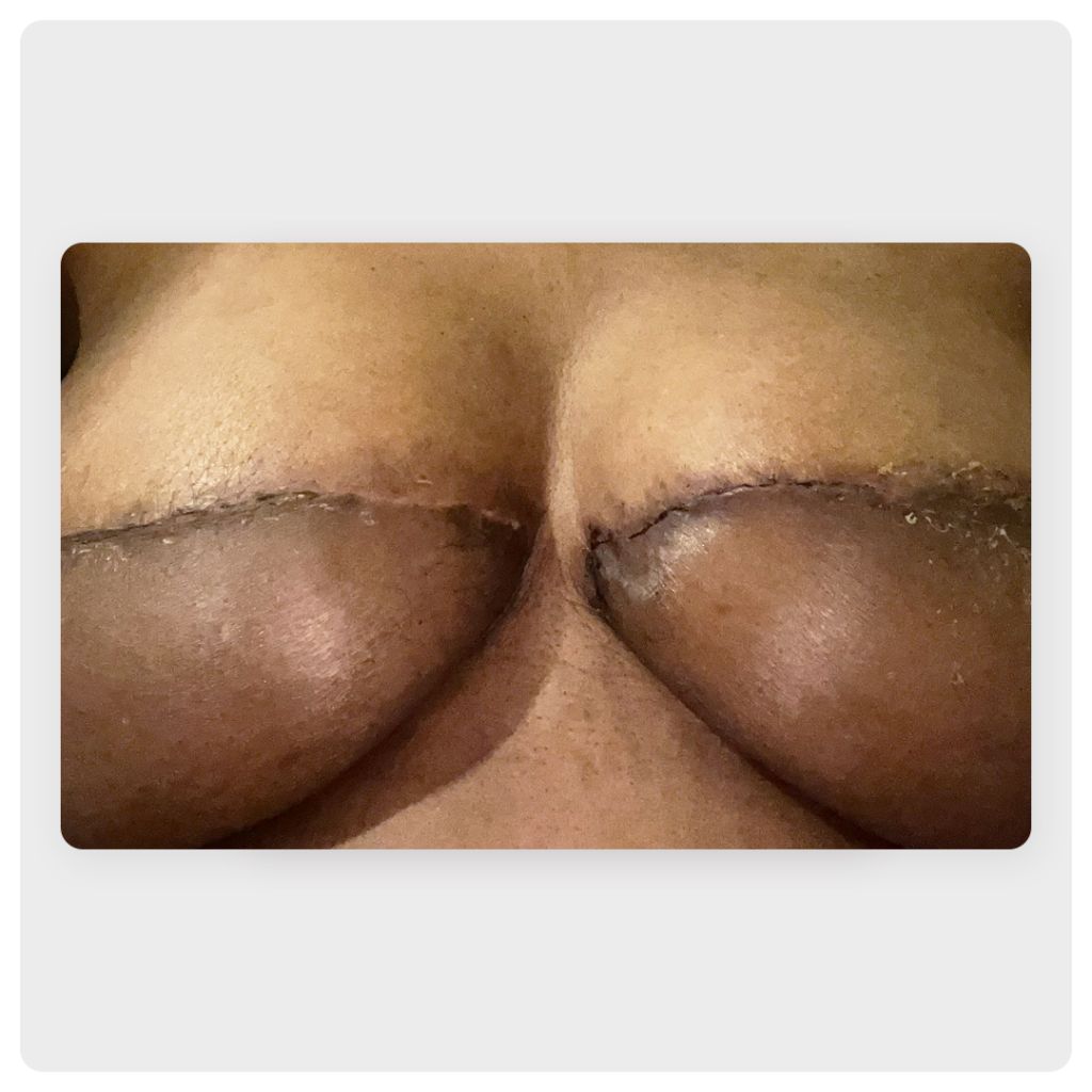 image of breasts with large lateral scar across center
