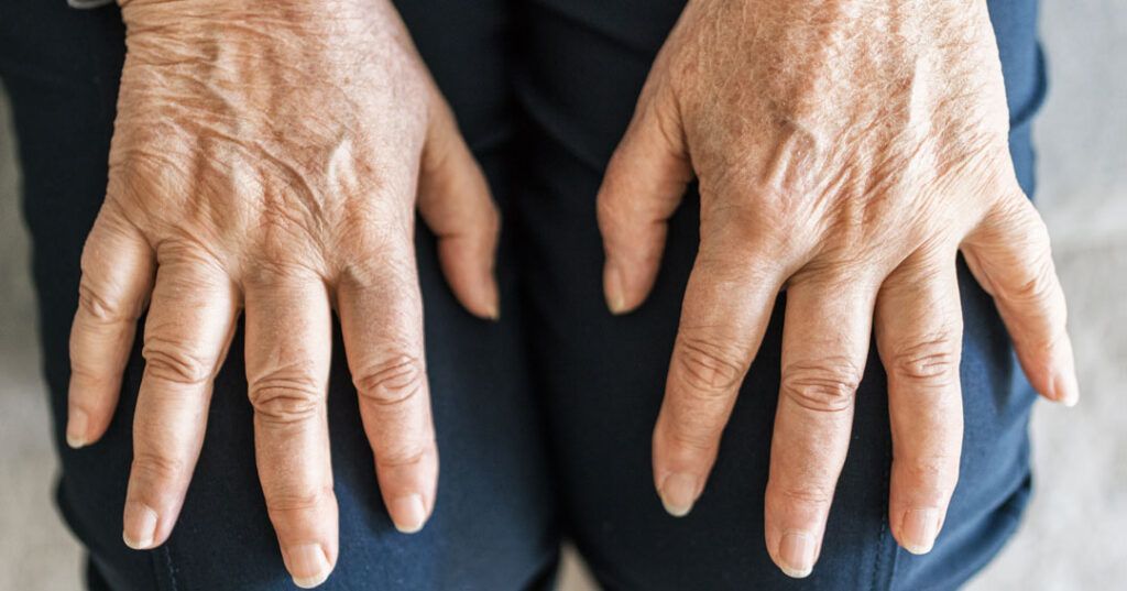 Image of swollen fingers from psoriatic arthritis resting on someone's lap.
