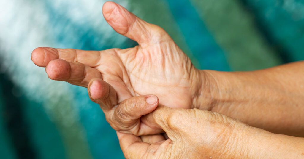Person with psoriatic arthritis stretching out their trigger finger.