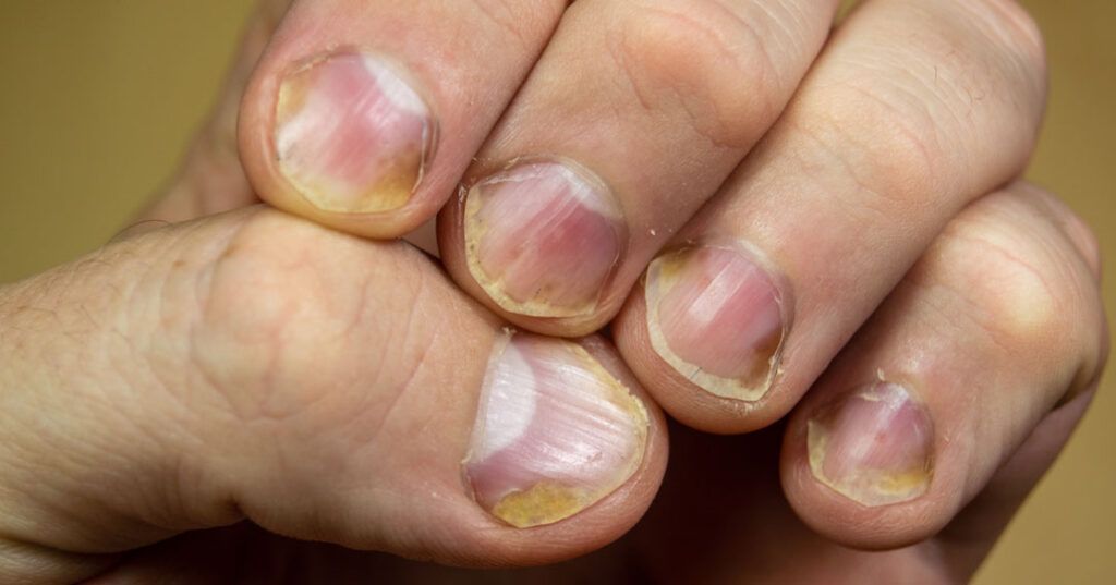 Image of fingernails with psoriasis.