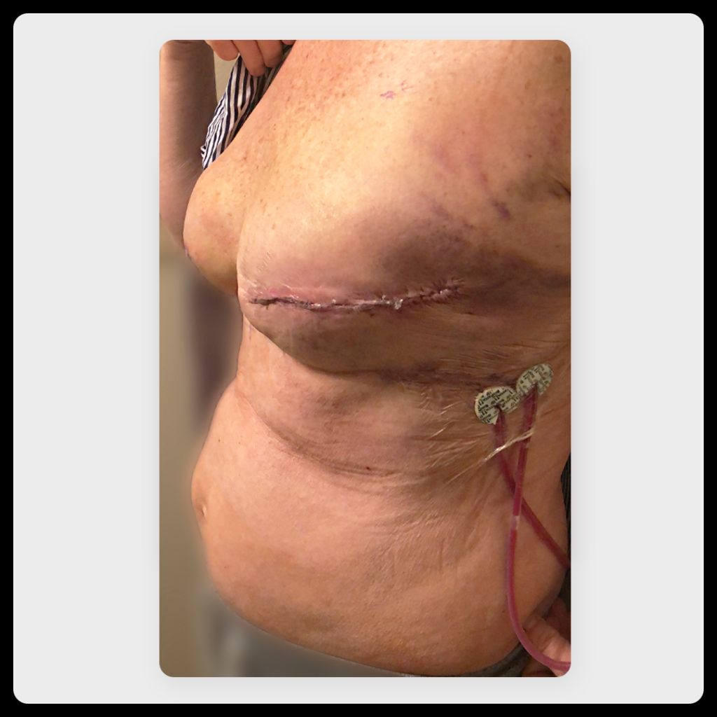 Side view of breast reconstruction and drainage port two weeks after surgery