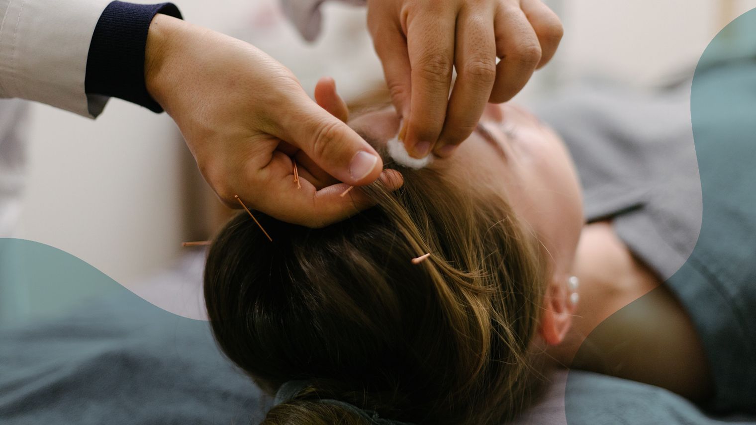 I Tried Acupuncture for Migraine: Here’s What Happened