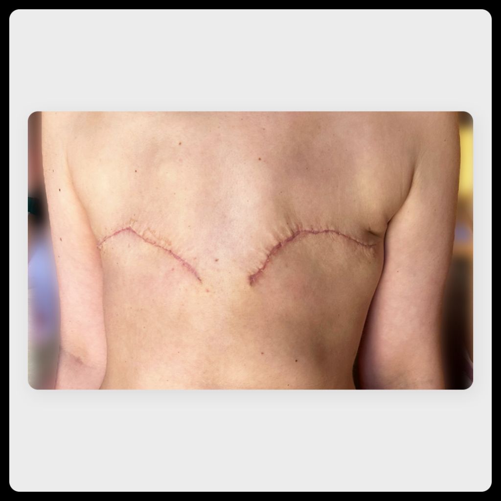 Aesthetic flat closure on a 34-year-old white woman after double mastectomy