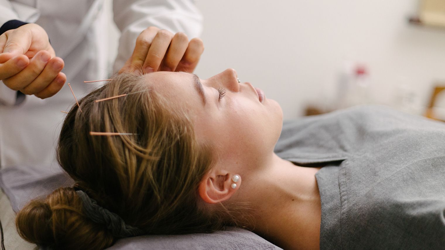 Can Acupuncture and Acupressure Help with Migraine Symptoms?