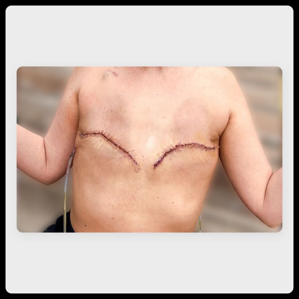 Aesthetic flat closure on a 34-year-old white woman after double mastectomy