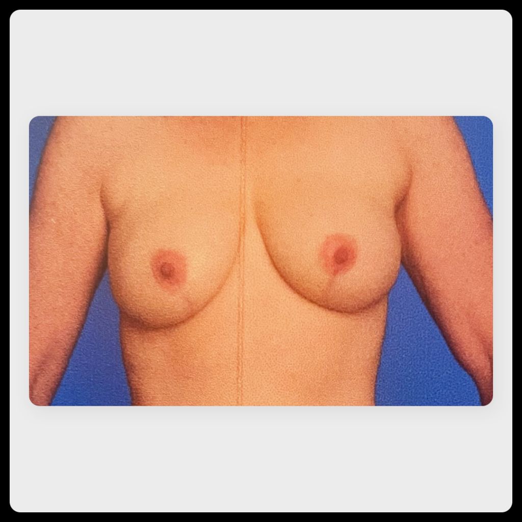 closeup image of breast reconstruction results after SGAP procedure and 1 to 3 months of healing