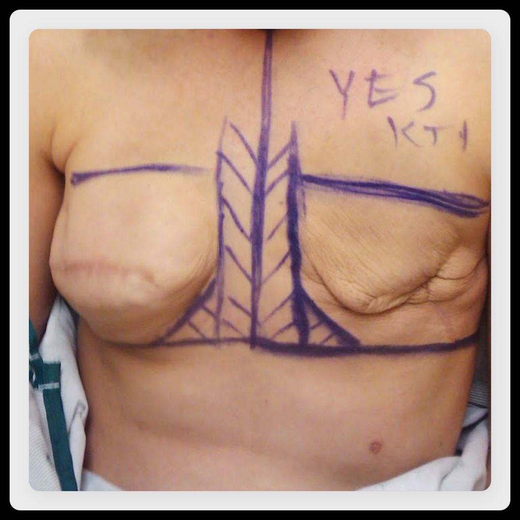 Image of surgical lines drawn on a woman's chest before having her second tissue expander removed