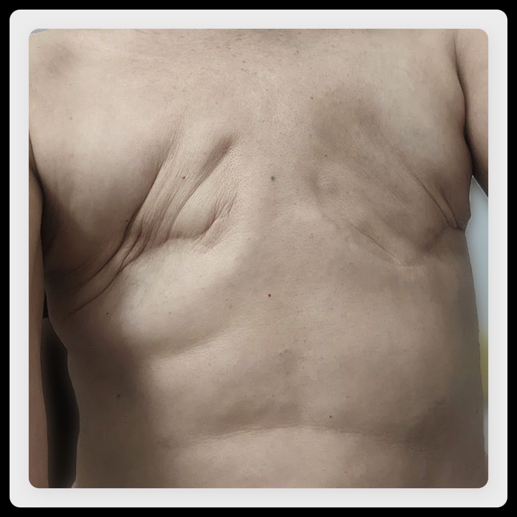 Woman's chest after having her tissue expanders removed