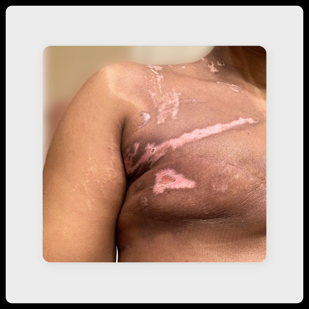 Image of scars 6 months to 1 year after a single mastectomy on a 35-year-old Black woman.