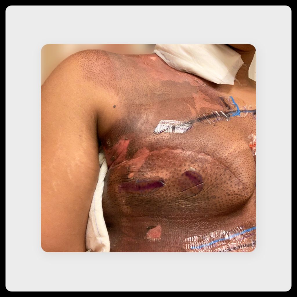 Image of scars 6 months to 1 year after a single mastectomy on a 35-year-old Black woman.