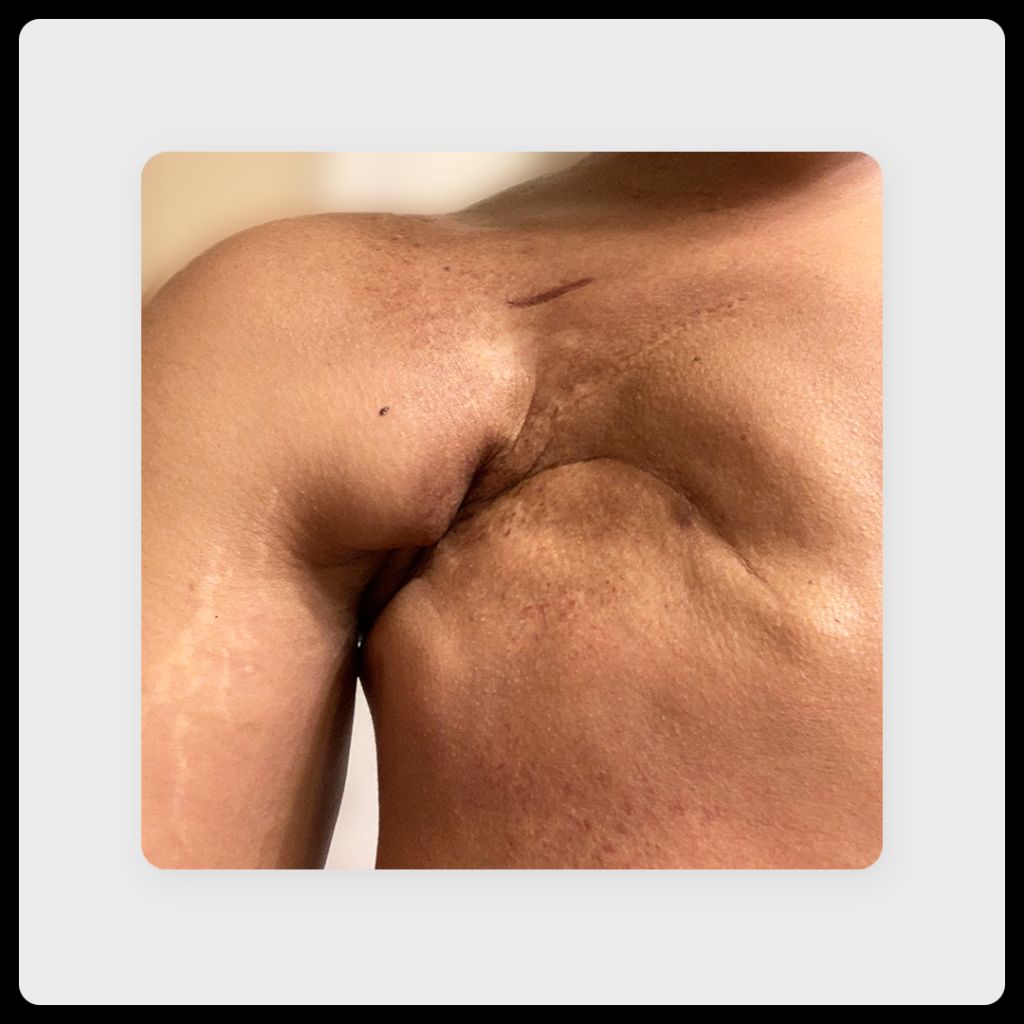 Image of scar over a year after tissue expander removal