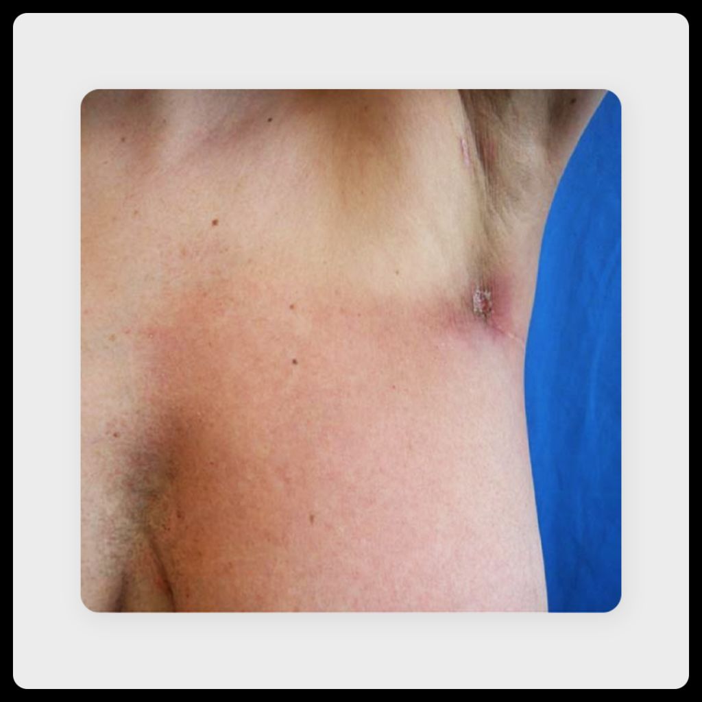 closeup image of minor breast cancer radiation burn