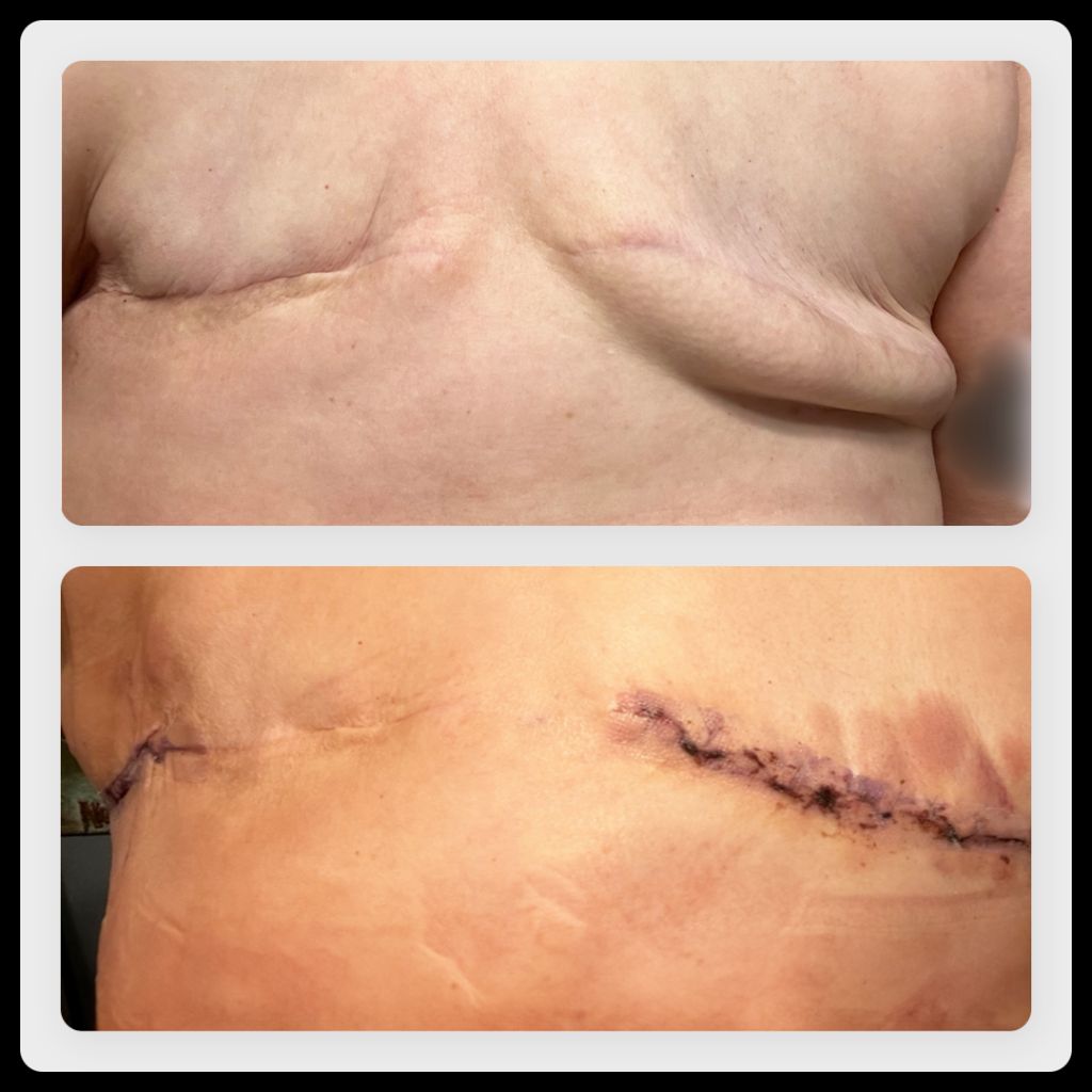 Images of a woman's chest after a double mastectomy and aesthetic flat closure scar revision surgery.