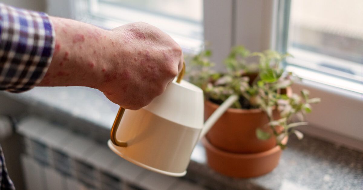 Exploring the Link Between IBD and Skin Conditions