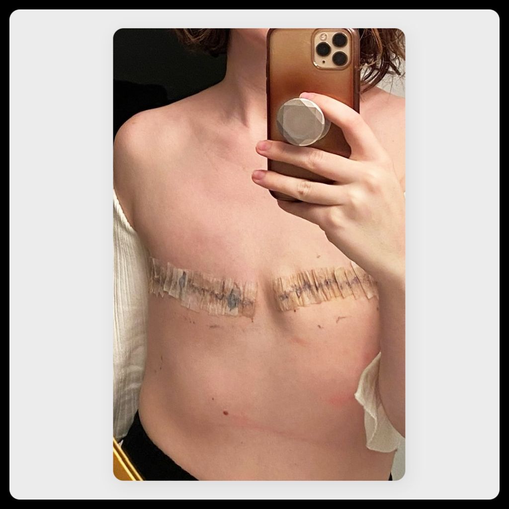 image of author two and a half weeks after double mastectomy with flat closure