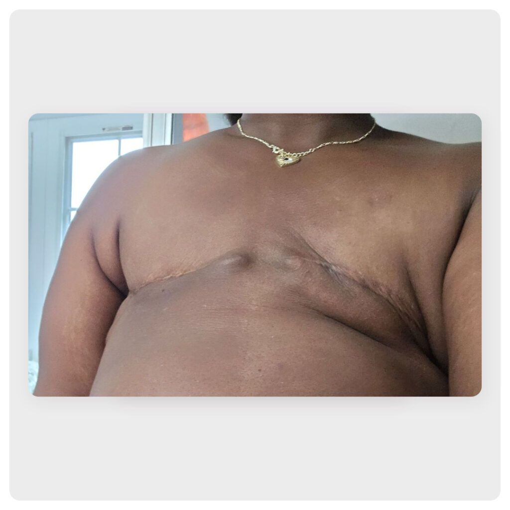 image of flat closure after a double mastectomy on a 37-year-old Black woman