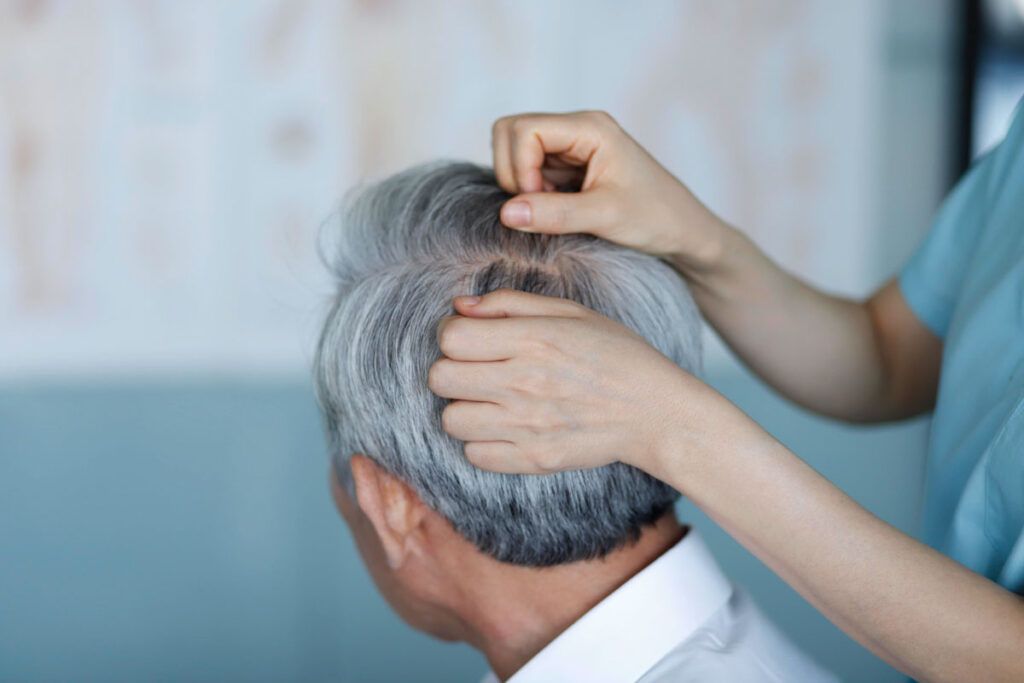 scalp psoriasis hair loss