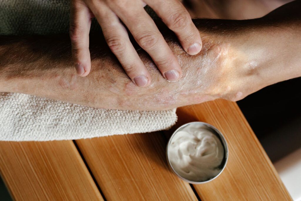 Close up of an older adult rubbing lotion into their ski which could be one of many natural remedies for shingles