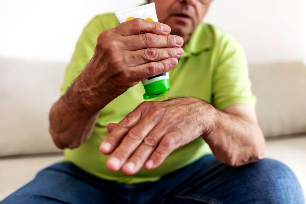 A person applying a topical ointment to their hand to treat weeping eczema.
