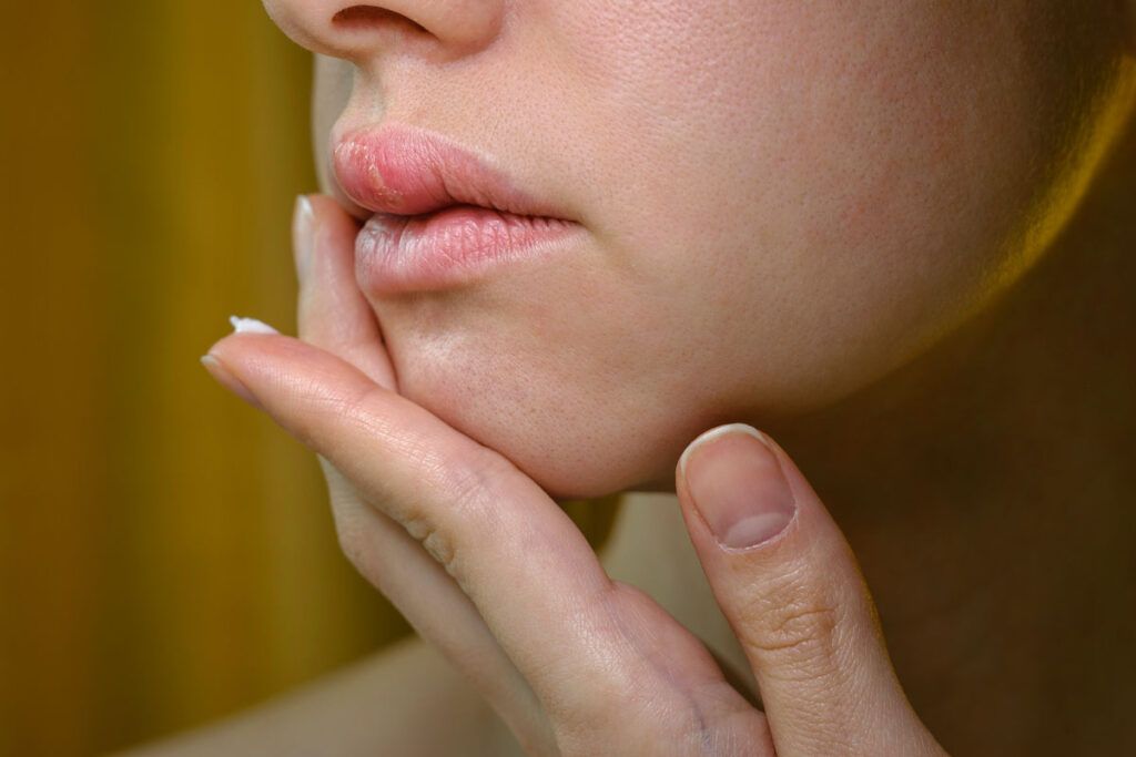 Woman with cold sores caused by the herpes virus touching her face