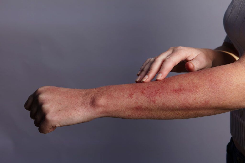 An image of someone with a HIV rash on their arm.
