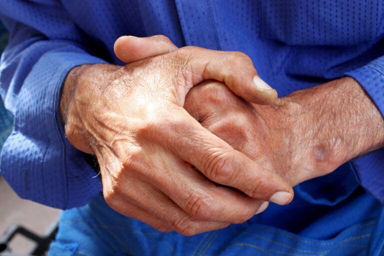 What is an RA rash and how is it treated? | Optum Perks