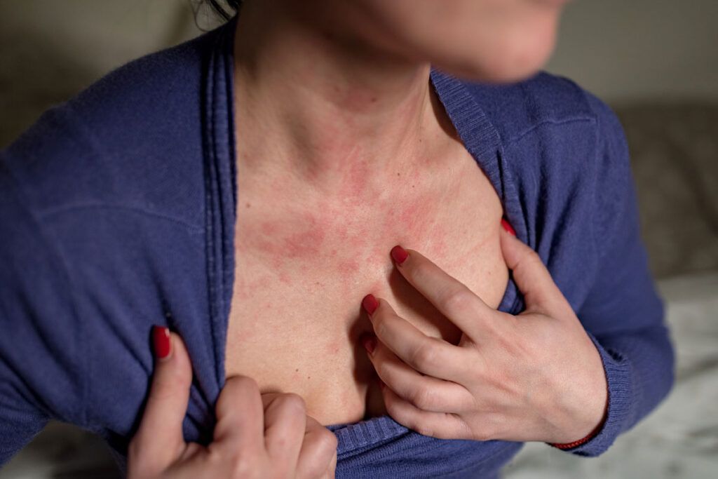 Female pulling her sweater away from her neck to show a Lamictal rash on chest and neck.