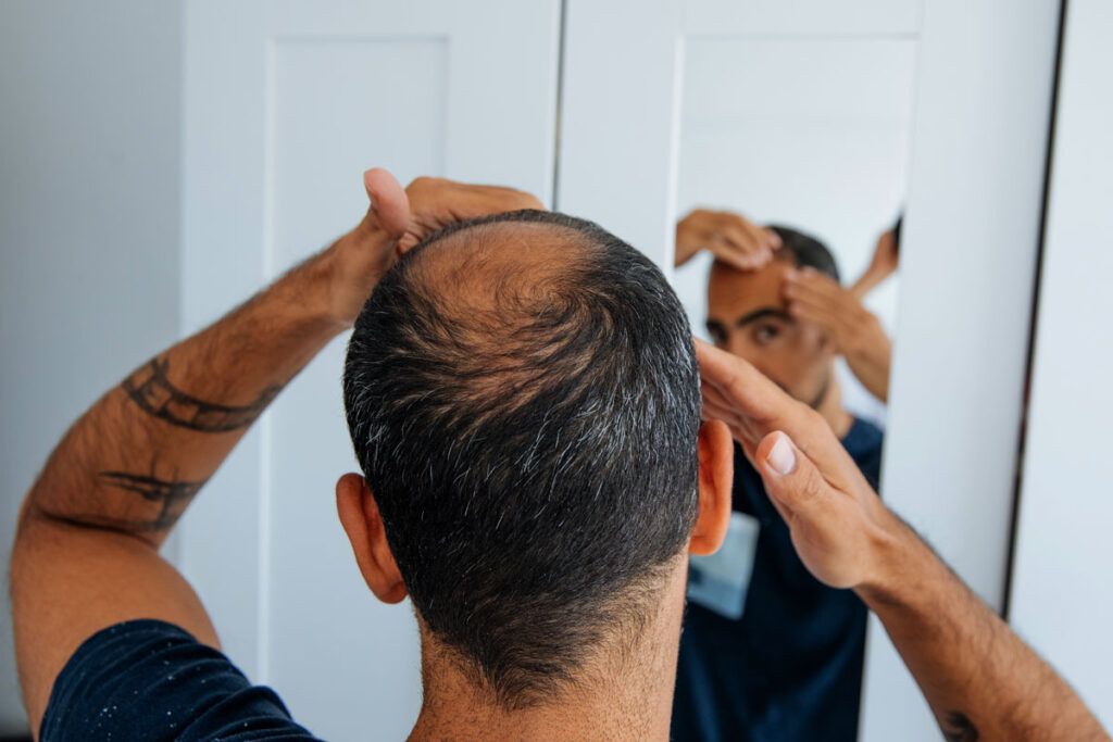Man taking finasteride for hair loss checking progress in the mirror