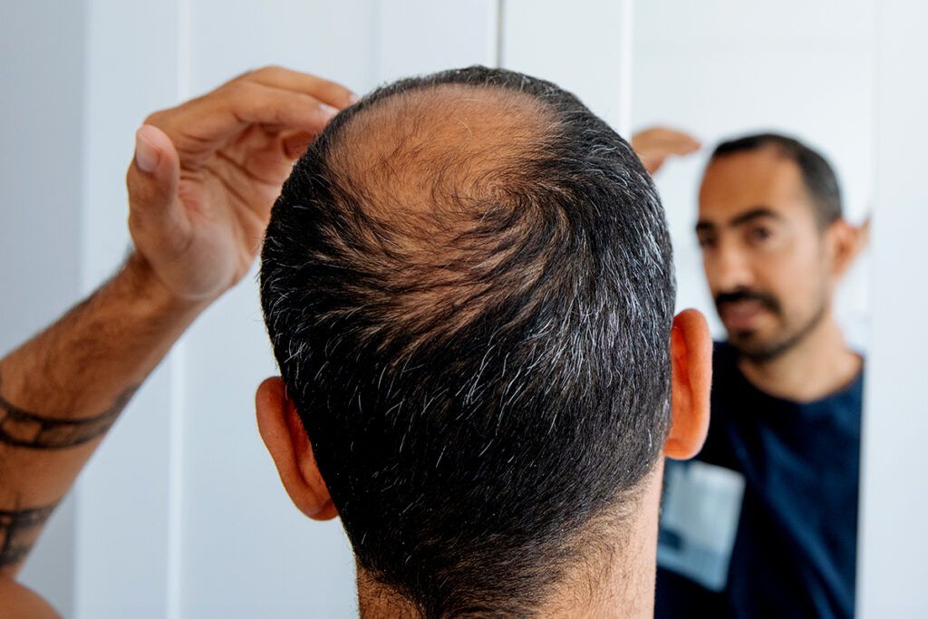 Health insurance coverage and hair loss treatments — What to know Optum Perks