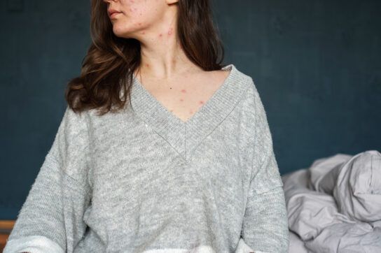 Person wearing a loose sweater with a v neck that shows chickenpox across the chest and neck.