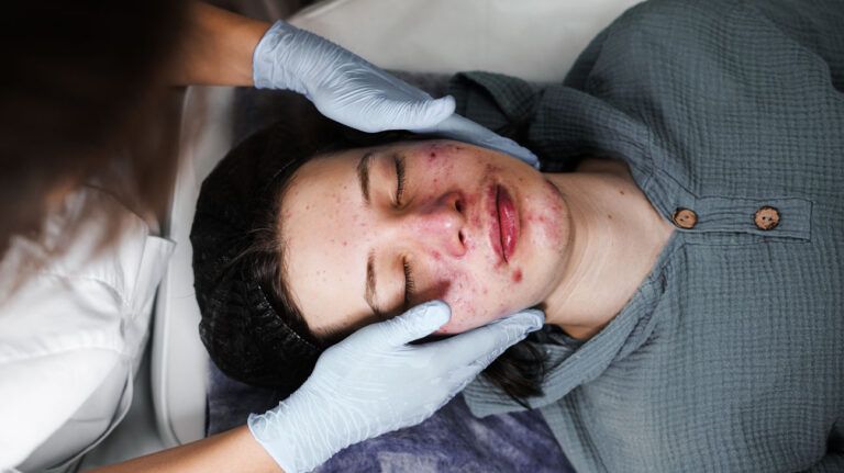 How do I get an Accutane prescription?